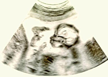 Universidade é acusada de usar bebês abortados em experiencias
